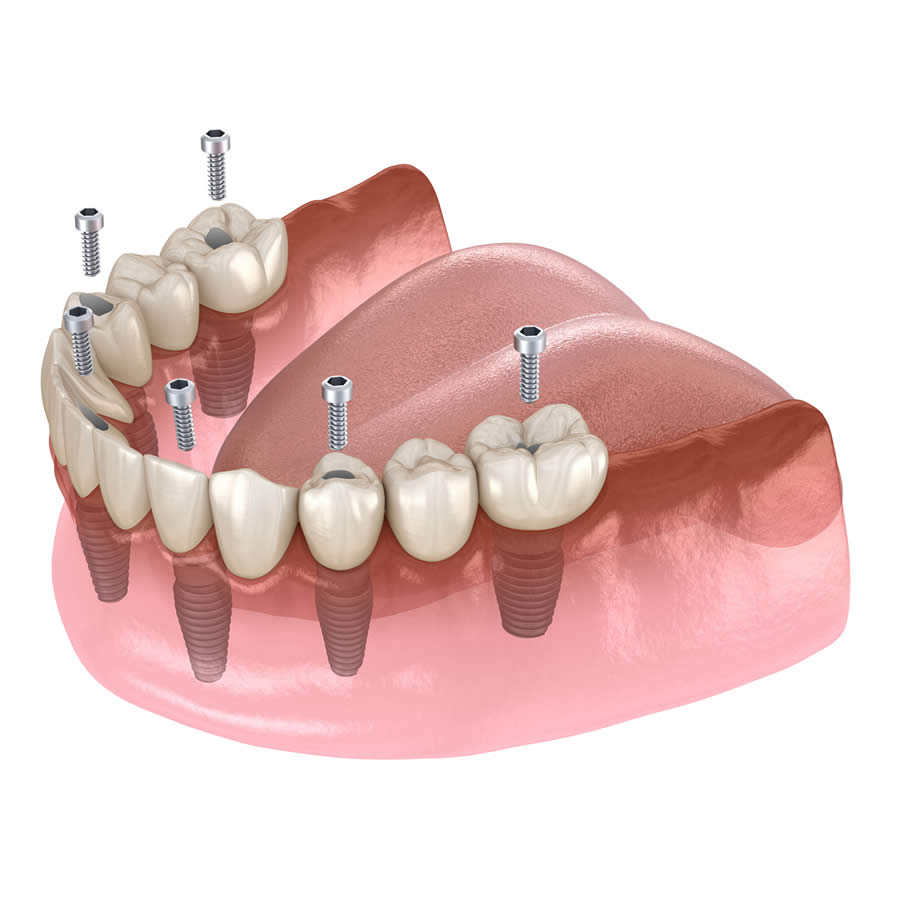Implantes dentales All on 6